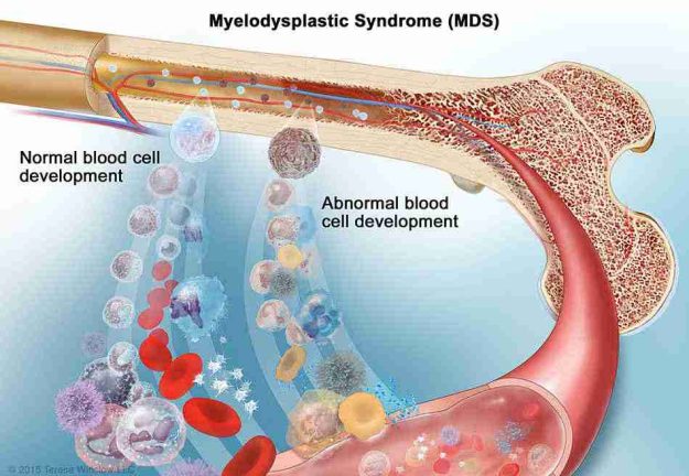 Myelodysplastic-Syndromes-MDS