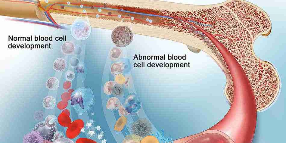Myelodysplastic-Syndromes-MDS