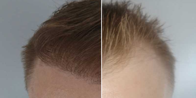 آزمایشات قبل از کاشت مو در کرج