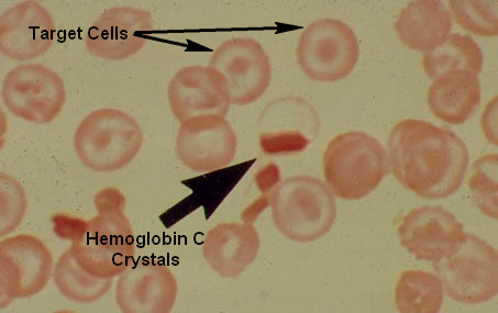Hemoglobin-C-Crystals-and-Target-Cells