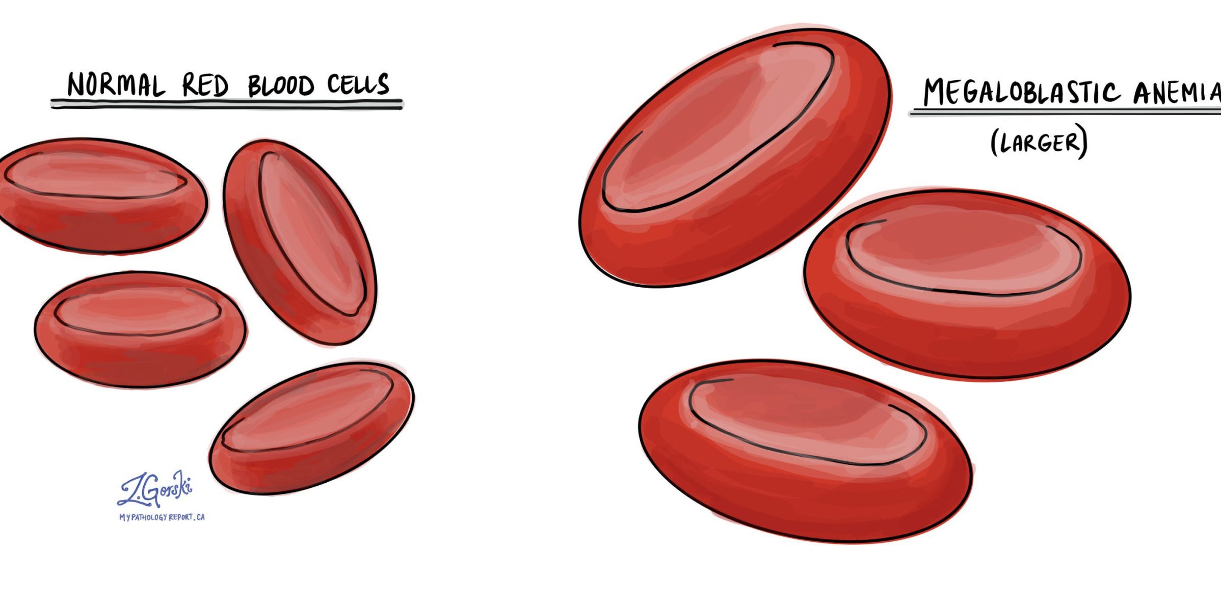 Megaloblastic-3000×1404