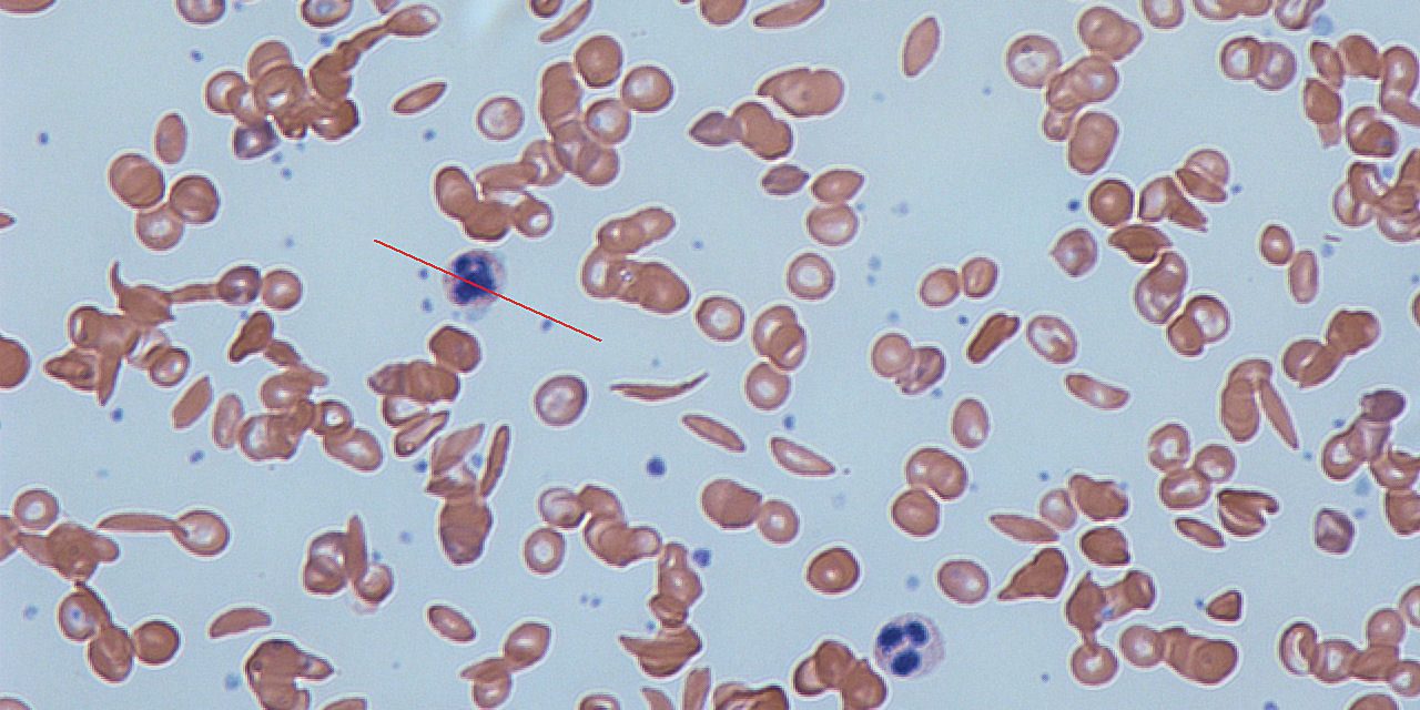 Sickle_cells