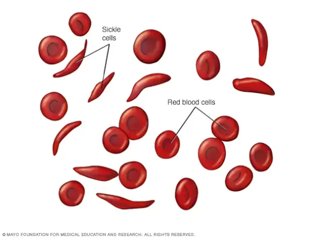 sickle-cell-anemia