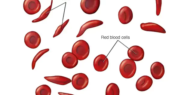 sickle-cell-anemia
