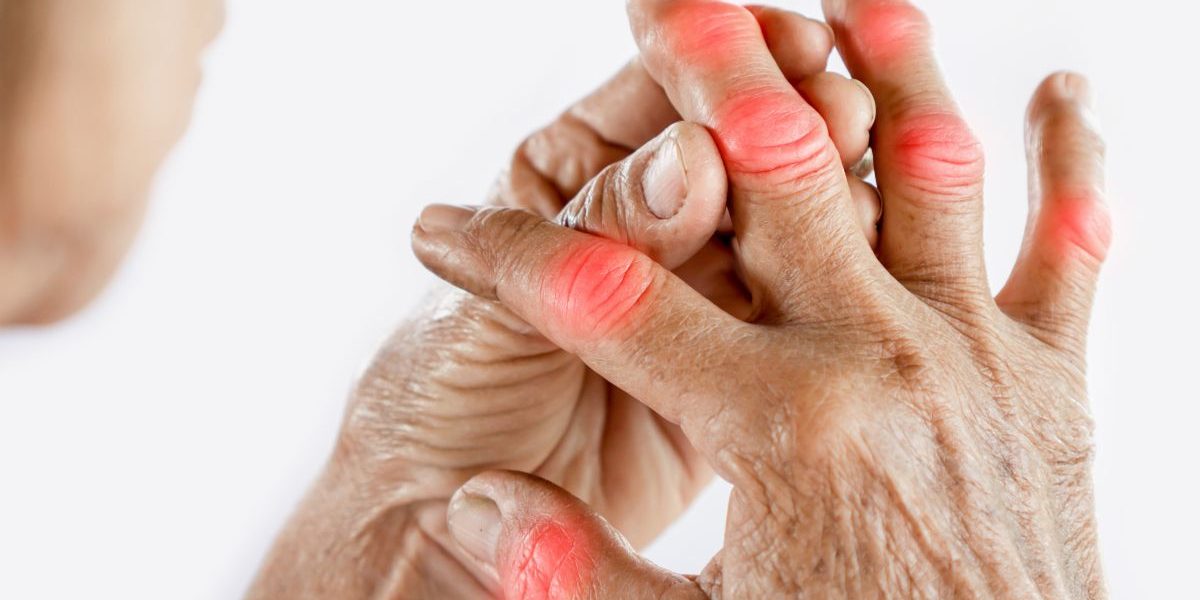 Rheumatoid-Arthritis
