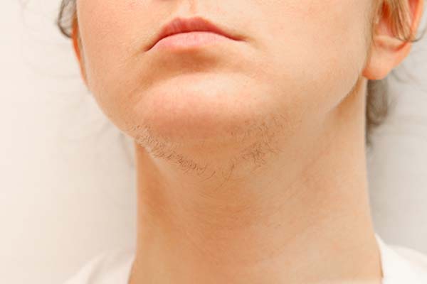 Epilation,On,The,Face,Of,A,Woman,With,Hair,On